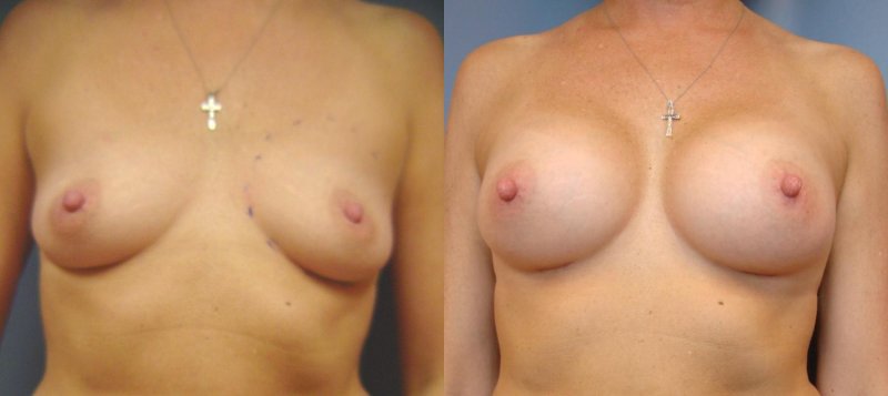 Anchor reduction mammoplasty, Breast reduction dr richard, Gynecomastia liposuction