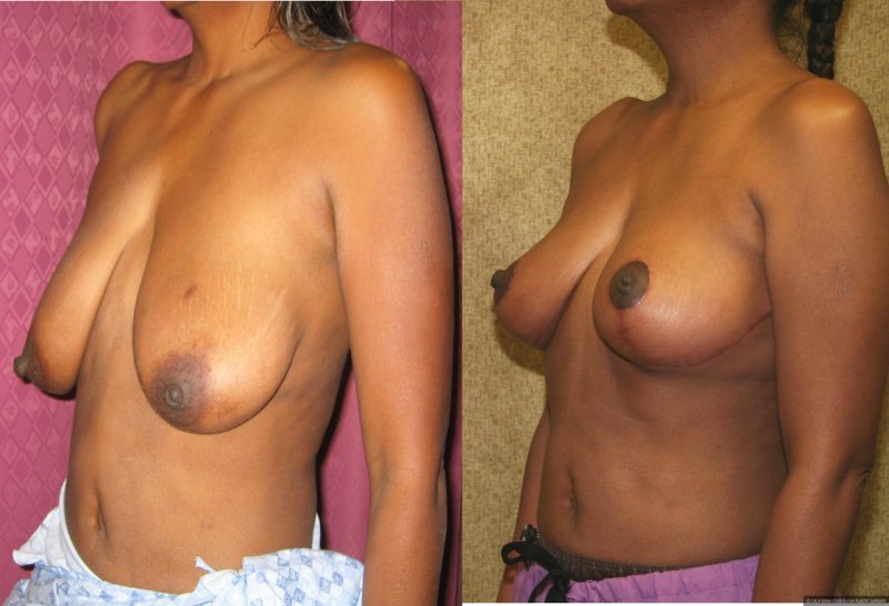 Breast reduction dr richard, Breast augmentation, Breast plastic