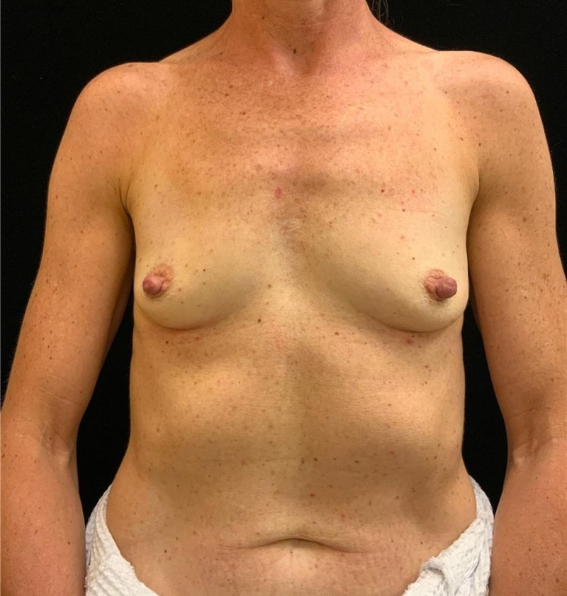 Breast enlargement, Breast augmentation, Breast plastic