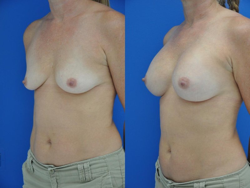 Breast augmentation, Breast implant, Breast plastic