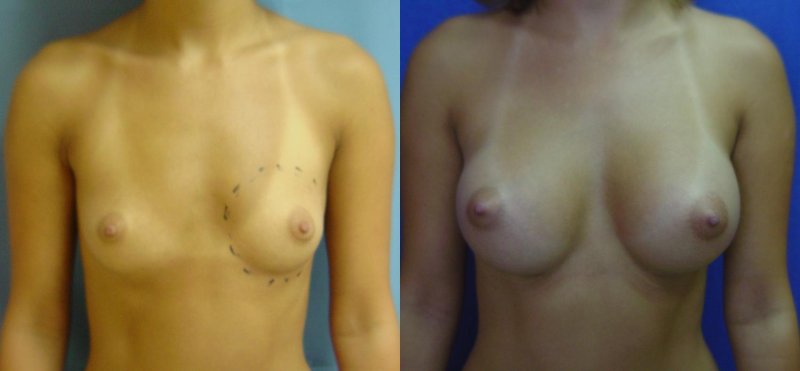 Breast augmentation, Breast plastic, Breast enlargement