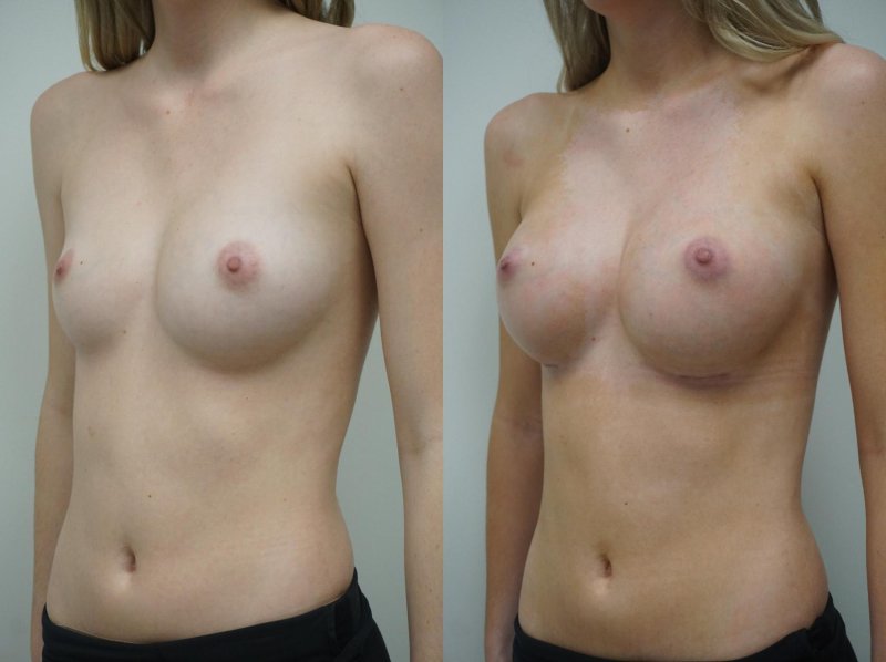 Breast augmentation, Breast enlargement, Breast plastic