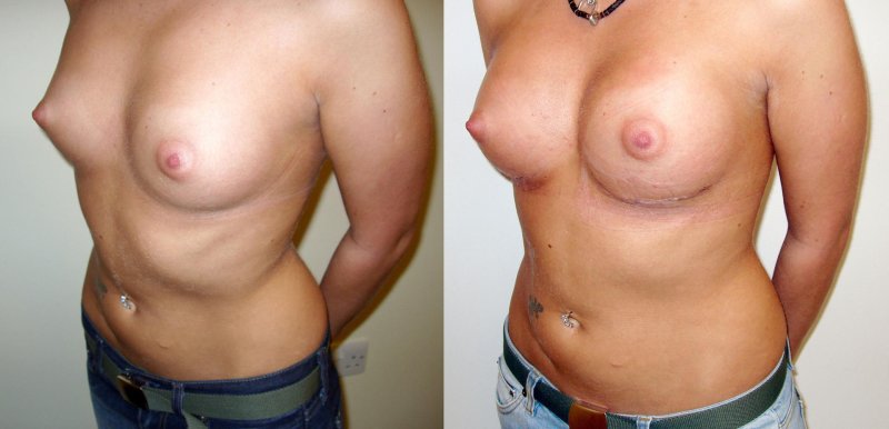 Tits with implants Naked, Chest with implants, Breast reduction dr richard