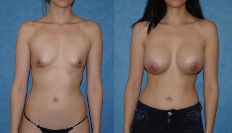 Increased breasts, For breast augmentation, Breast augmentation