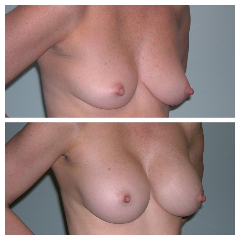 Breast plastic, For breast augmentation, Before and after breast augmentation