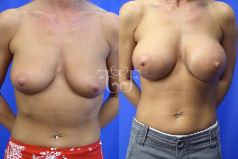 Breast plastic, Breast augmentation, Breast enlargement