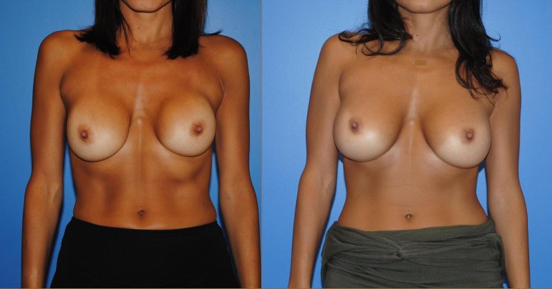 Breast augmentation, Breast plastic, Breast implant