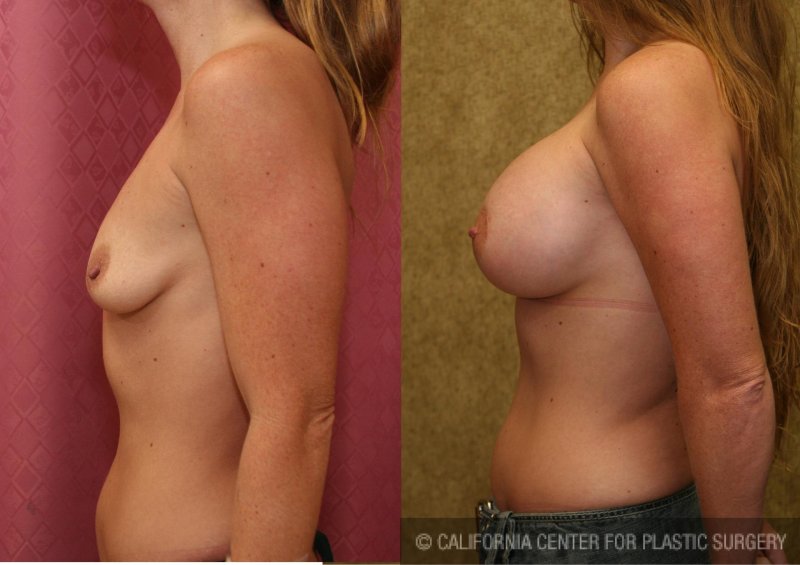 Breast augmentation, Nikki benz before and after breast enhancement, For breast augmentation