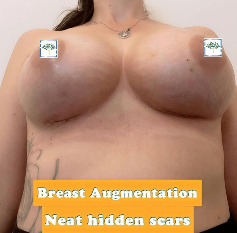 Breast augmentation, Breast implant, Breast enlargement