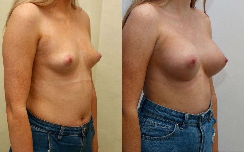 False gynecomastia, Breast plastic, Before and after breast augmentation