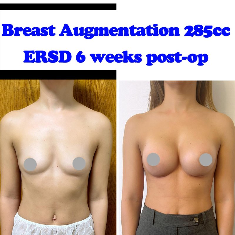 Breast augmentation, Breast implant, Breast plastic