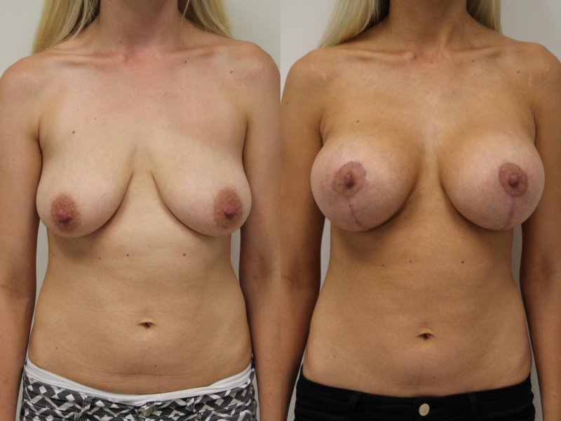 Breast enlargement, Breast enlargement with fat, Breast enlargement with implants