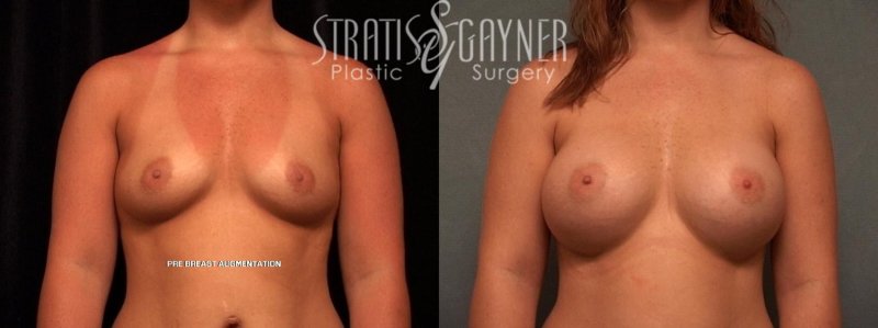 Breast augmentation, Breast reduction dr richard, Nikki benz before and after breast enhancement