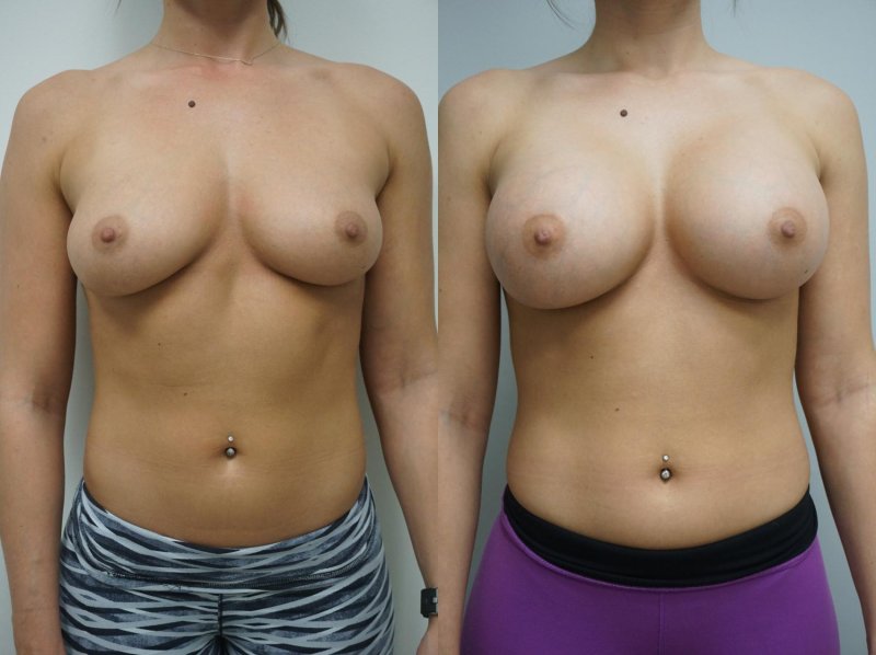 Huge boobs implants, Before and after breast augmentation, Gynecomastia liposuction