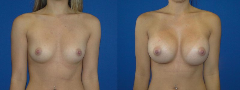 Breast plastic, Breast enlargement, Breast reduction dr richard