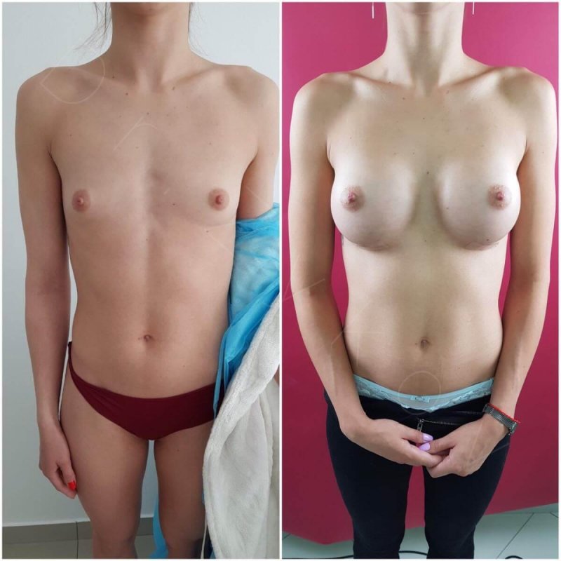 Increased female breasts, Before and after breast augmentation, Breast enlargement