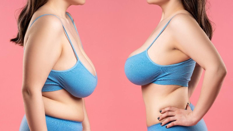 Sagging breasts, Breast reduction, Very big breasts