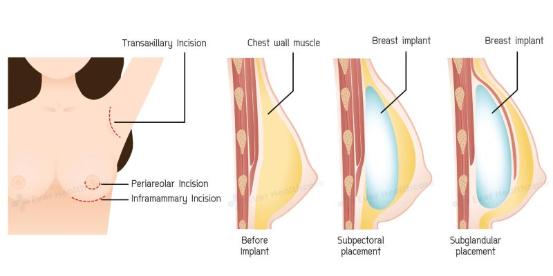 Breast implant, Breast augmentation, Implants are thoracic
