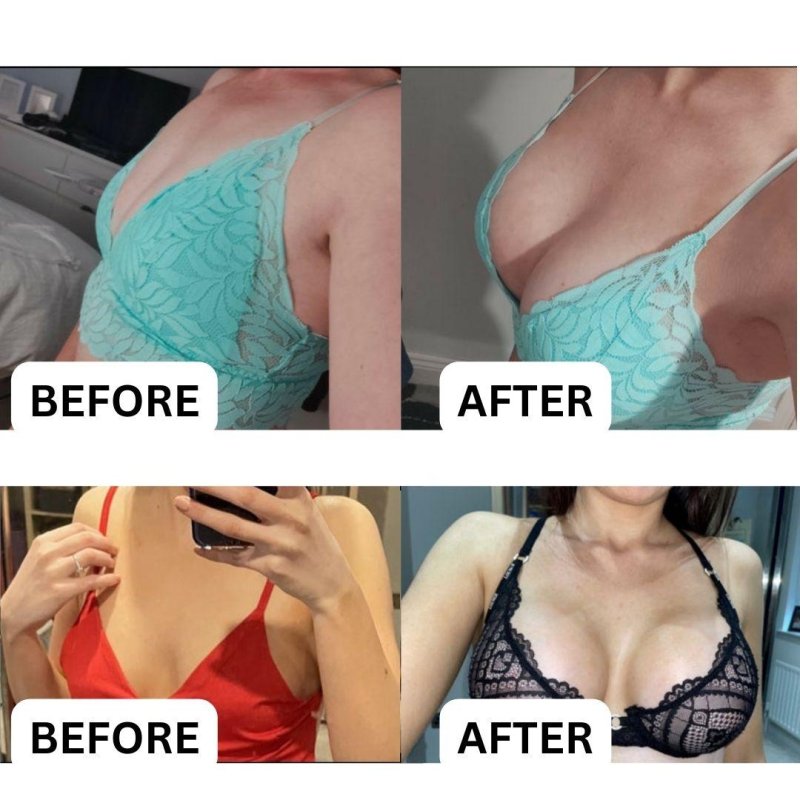 Before and after breast augmentation, For breast augmentation, After before