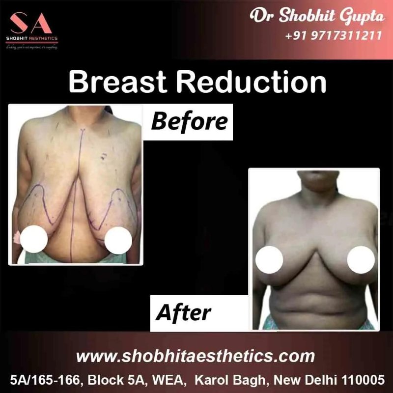 Breast reduction, Breast enlargement, Breast augmentation