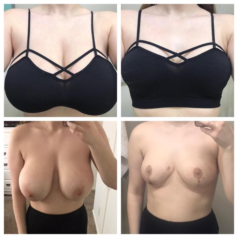 For breast augmentation, Brows, Before and after breast augmentation