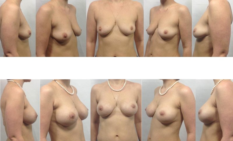 Breast form, Breast plastic, Form of the female breast