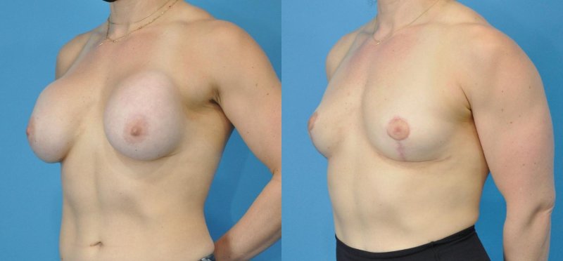 Breast implant, Breast reduction dr richard, Breast plastic