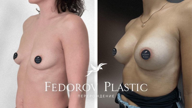 Breast plastic, Pavel Korneev Plastic Surgeon, Silicone breast
