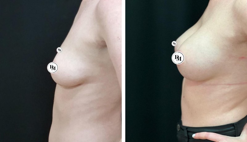 Augmentation mammoplasty, Breast plastic, Breast enlargement