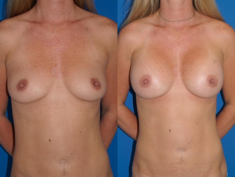Breast plastic, Breast reduction dr richard, Breast enlargement