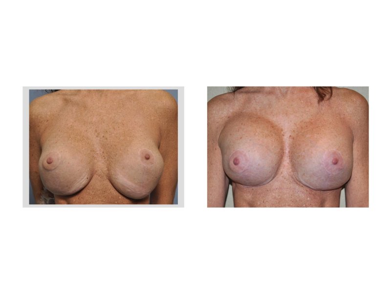 Breast enlargement with implants, Breast implant, Breast enlargement