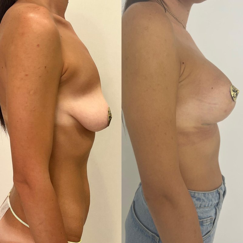 Periarelar mastopexia, Mammoplasty before and after, Breast pullenging with implants