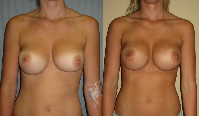 Enlarged breasts without clothes, Before and after breast augmentation, Breast enlargement