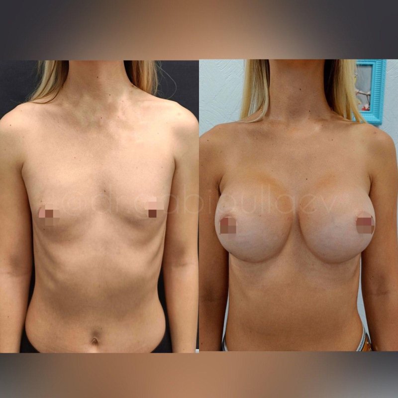 Breast enlargement, Operation Breast enlargement, Breast plastic