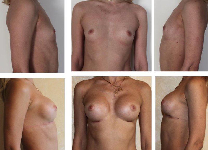 Unusual chest shape, Breast plastic, Breast enlargement