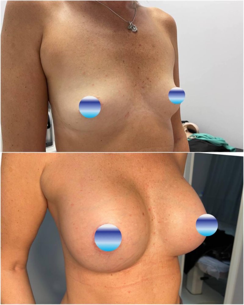 Breast implants, Breast enlargement, Breast plastic