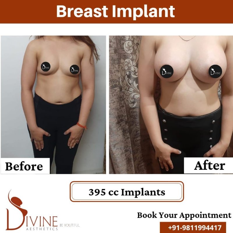 For breast augmentation, Breast implant, Breast augmentation