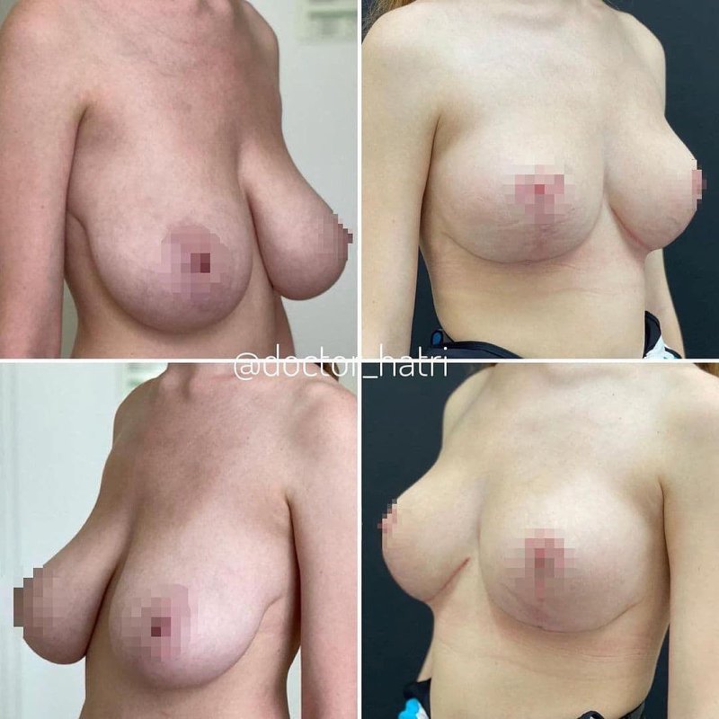 Reducing and lifting breast, Breast reduction, For breast augmentation