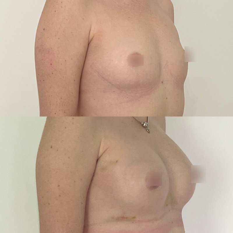 Endoscopic breast augmentation, Before and after breast augmentation, Breast enlargement