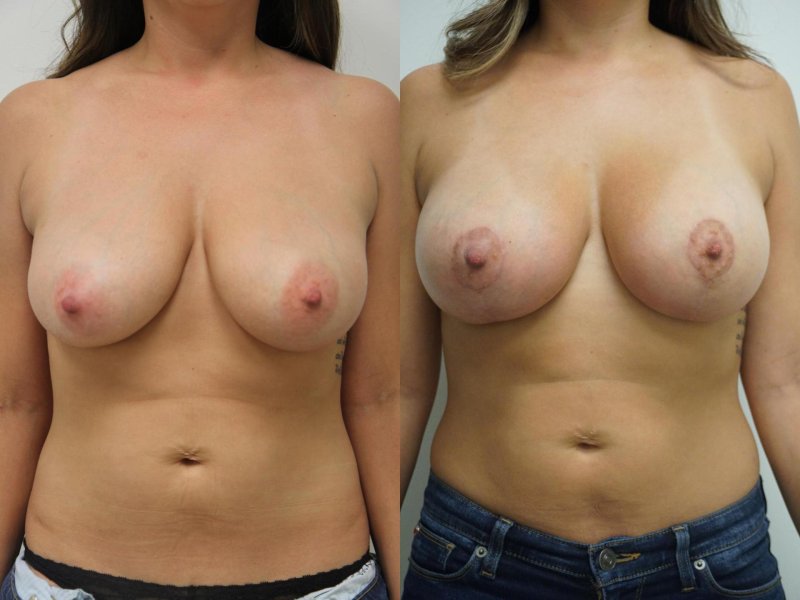 Breast plastic, Lower breast sagging naked, Before and after breast augmentation