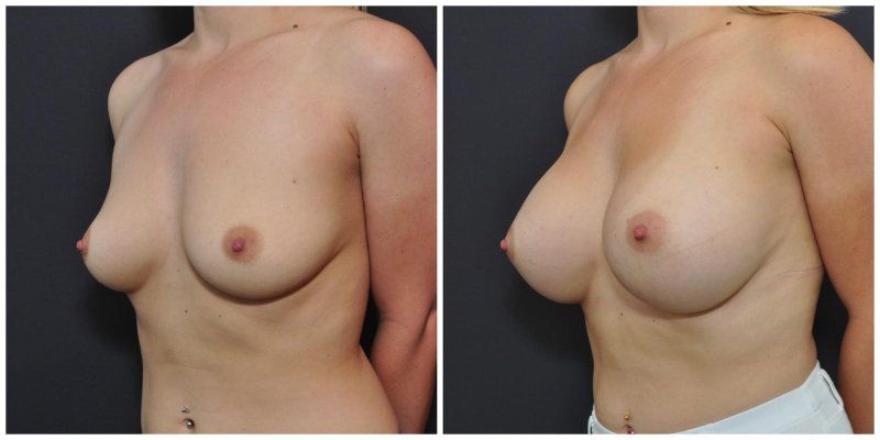 Breast plastic, For breast augmentation, Before and after breast augmentation