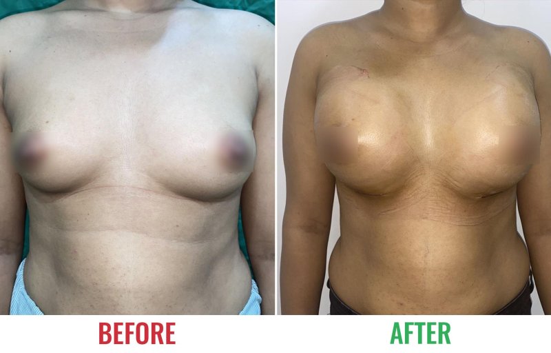 Breast implant, Breast reduction dr richard, Breast enlargement