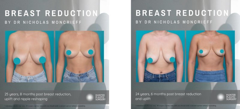 Breast augmentation, Breast reduction, Breast enlargement