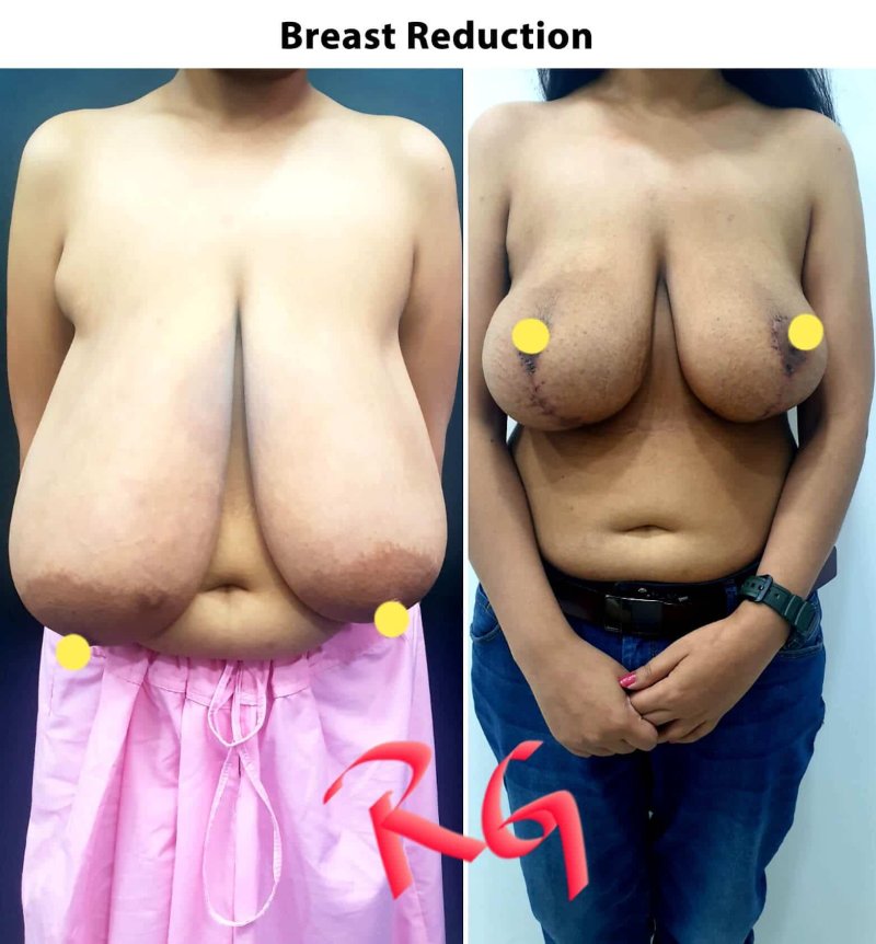 Breast reduction operations, Reducing the pectoral glands, Breast reduction