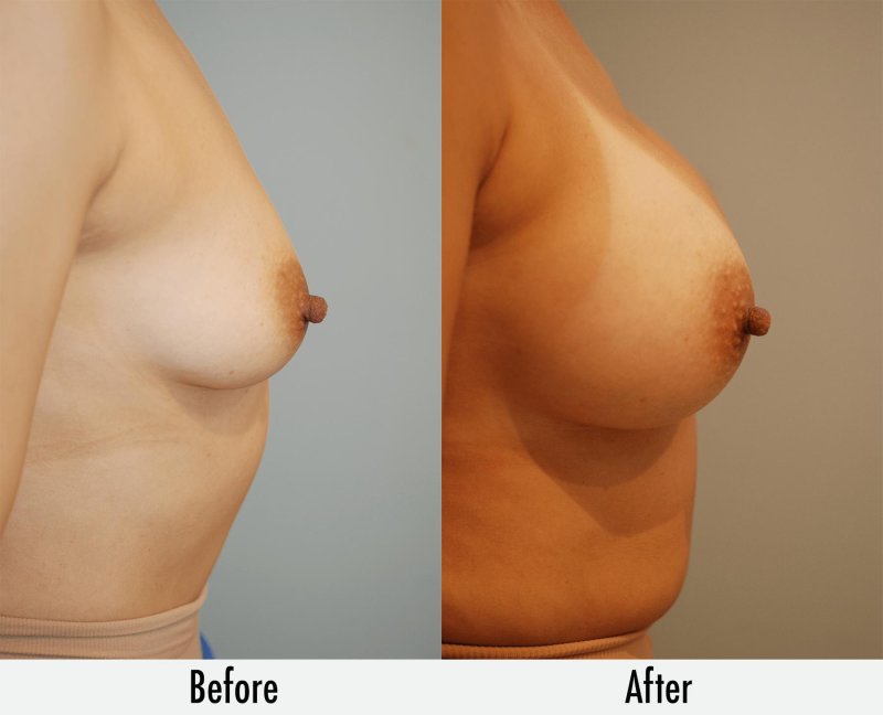 Breast augmentation, Extra large breast augmentation before after, Breast plastic