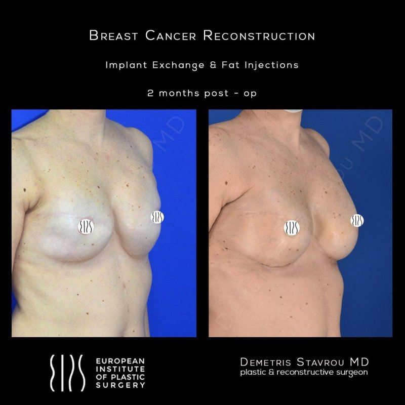 Reconstructive mammoplasty, Breast reconstruction after a mastctomy, Breast reconstruction