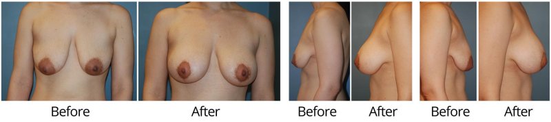 Extra large breast augmentation before after, Breast enlargement, Breast augmentation