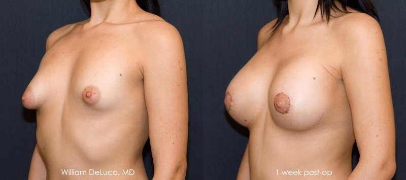 Konus -shaped breasts are naked, Breast plastic, Breast enlargement