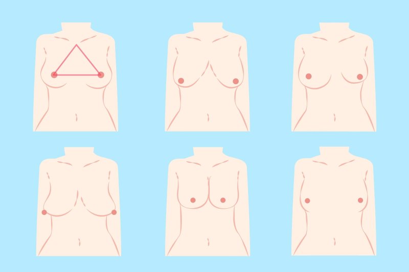 Conical shape of the chest, Varieties of breast shapes, Various forms of the chest