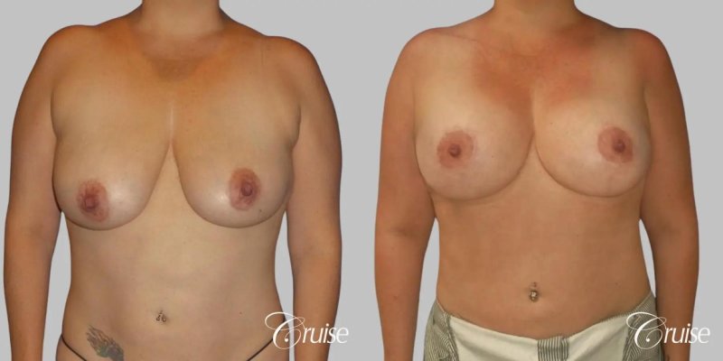 Breast augmentation, Nikki benz before and after breast enhancement, Before and after breast augmentation